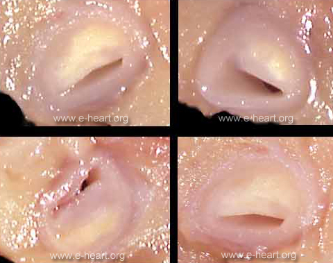 CAV and atherosclerosis